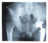 X-ray of Pill images at the Hip