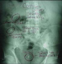 X-Ray of Name Brand Pills Stuck in the GI Tract