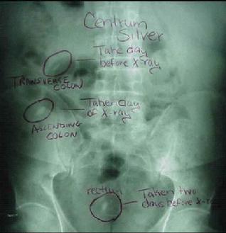 Hip X-Ray Showing Pills & Capsules Stuck in the Gut